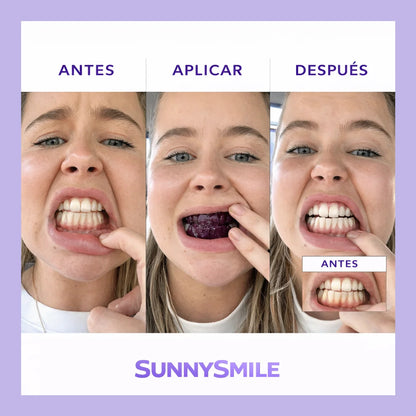 SUNNYSMILE™ – Bringe dein Lächeln in nur 30 Minuten zum Strahlen