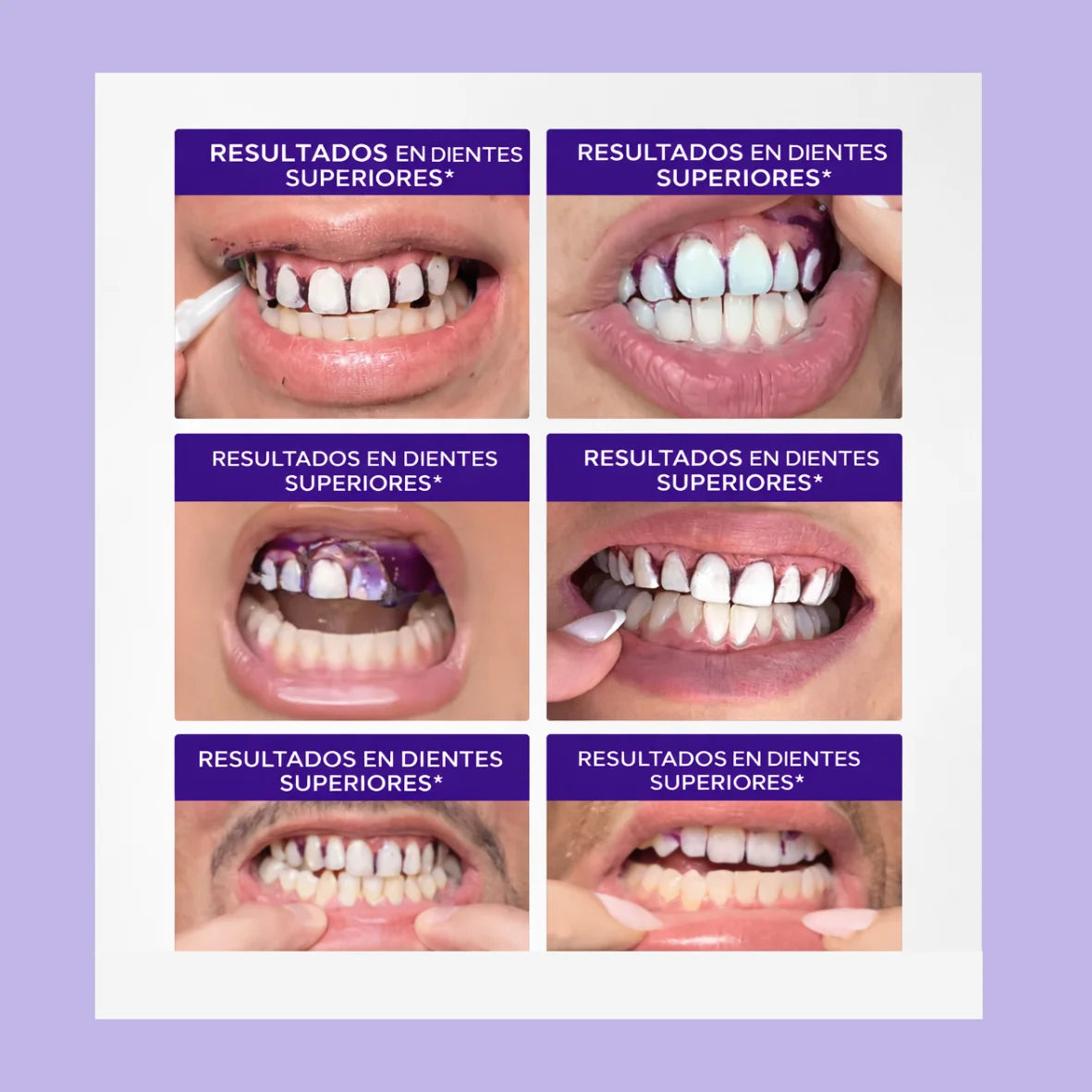 SUNNYSMILE™ – Bringe dein Lächeln in nur 30 Minuten zum Strahlen